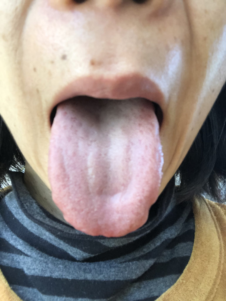 舌 の ふち が でこぼこ