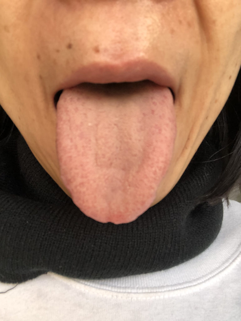 自分の舌見ていますか 舌の形からわかる体調 妊活 不妊治療にオンラインヨガ セルフケア Hoshi